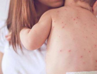 Già 864 casi di morbillo nel 2019 in Italia: l’Emilia-Romagna è tra le regioni più colpite